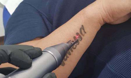 Remove Tattoo from Laser Machine