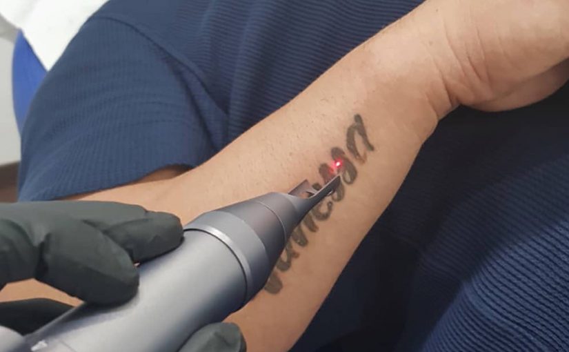Remove Tattoo from Laser Machine