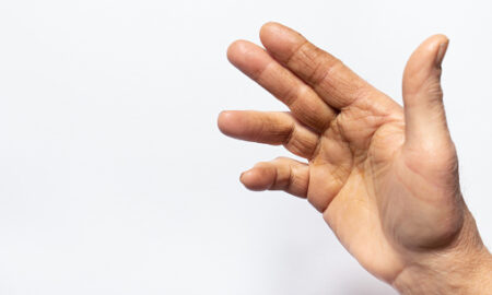 Dupuytren’s Contracture