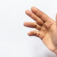 Dupuytren’s Contracture