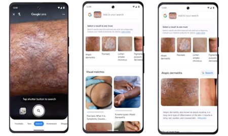 Identify Skin Conditions with Google Lens