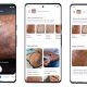 Identify Skin Conditions with Google Lens