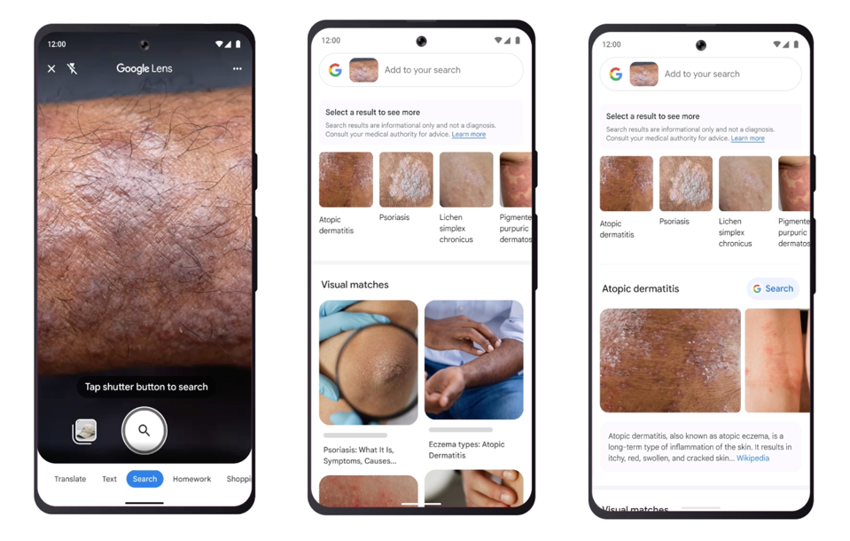 Identify Skin Conditions with Google Lens