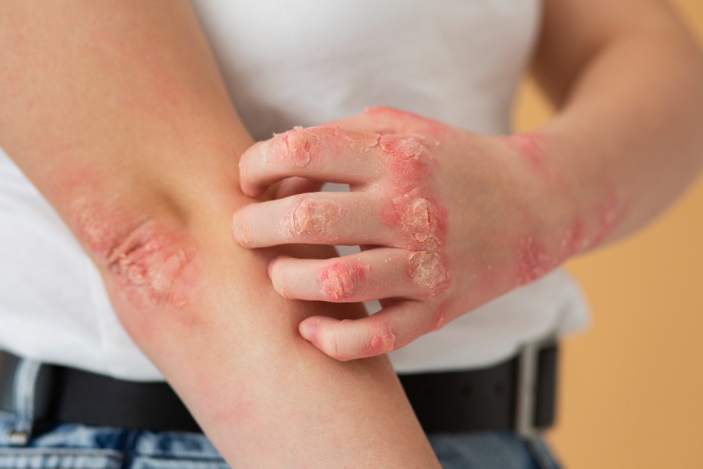 What are the Signs and Symptoms of Heat Rash?