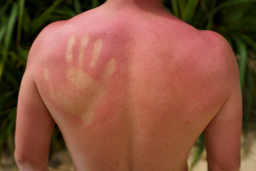 What Does Mean By Heat Rash in Kids?