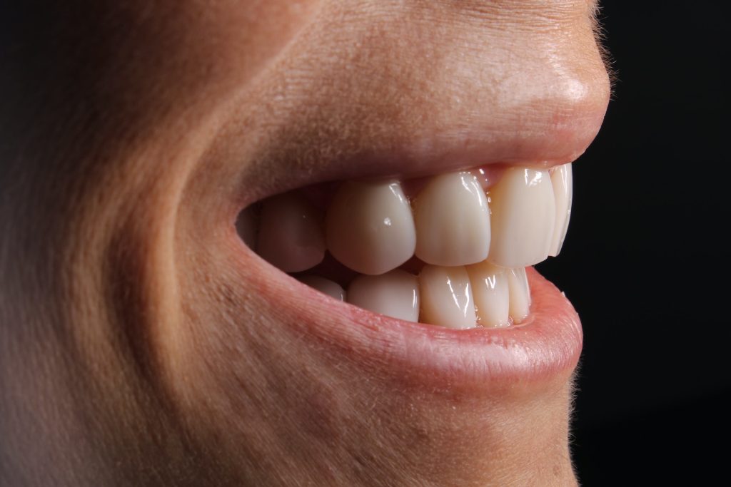 What are Veneers?