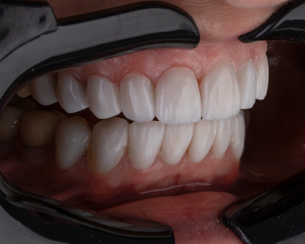 What are Porcelain Veneers?